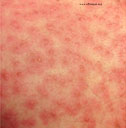 Herpesvirus 3, Human (Varicella zoster virus)
