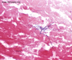 Figure 1. Gram stain of hepatic aspirate, showing <i>Actinomyces israelii</i>.