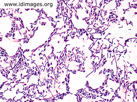 Figure 1. Gram stain of <i>Clostridium septicum</i>, from culture growth of soft tissue infection.