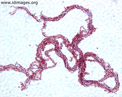 Figure 1. Acid-fast stain of <i>Mycobacterium  tuberculosis</i>, from culture of lymph node  aspirate. 