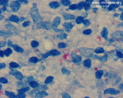 Figure 2.  Kinyoun stain of skin biopsy, showing  <i>Mycobacterium leprae</i>.