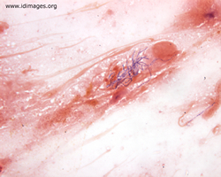 Figure 1.  <i>Nocardia nova</i> complex, seen on  sputum gram stain.
