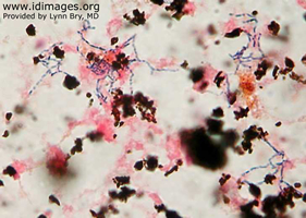 Figure 2.  Gram stain of blood culture, growing  <i>Nocardia asteroides</i>.