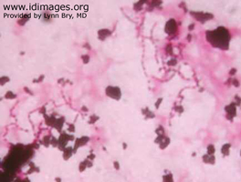 Figure 3.  Modified acid-fast stain of <i>Nocardia  asteroides</i> in blood culture.