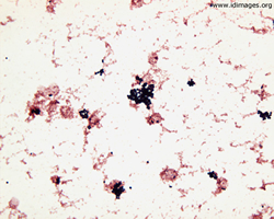 Figure 1. Gram stain of aerobic blood culture,  with <i>Staphylococcus aureus</i>, methicillin sensitive.