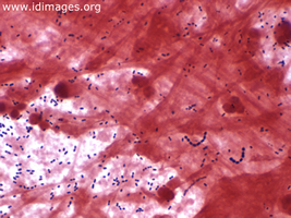 Figure 1.  Gram stain of sputum specimen,  showing <i>Streptococcus pneumoniae</i>.