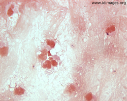 Figure 2.  Gram stain of liver aspirate, with <i>Fusobacterium nucleatum</i>.