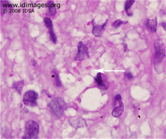 Figure 3.  <i>Klebsiella pneumoniae</i> ssp. rhinoscleromatis, PAS stain of epiglottis biopsy specimen.