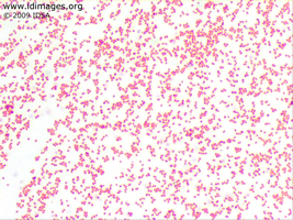 Figure 1.  Gram stain of <i>Neisseria gonorrhoeae</i>  from blood culture growth.