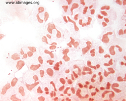 Figure 3.  Gram stain of spun CSF showing <i>N.  meningitidis</i> diplococci.
