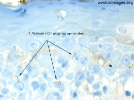 Figure 2.  Immunostain of skin biopsy showing  <i>Treponema pallidum</i> spirochetes.