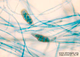 Figure 2. <i>Alternaria</i>, by lactophenol blue stain  (80x magnification).