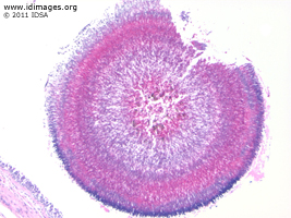 Figure 2. <i>Aspergillus fumigatus</i> gram stain of brain abscess aspirate.