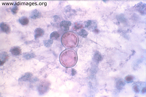 Figure 1.  <i>Blastomyces</i>, on cytologic examination.