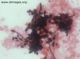 Figure 1.  <i>Candida dubliniensis</i> on gram staIn of cerebrospinal fluid. 