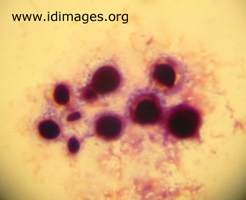 Figure 1.  Gram stain of <i>Cryptococcus neoformans</i>