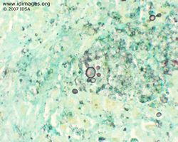 Figure 1.  <i>Paracoccidioides</i> shown by GMS  stain in lung biopsy.