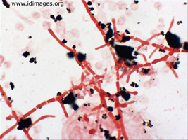 Figure 1. <i>Penicillium marneffei</i> on gram stain of  blood culture.