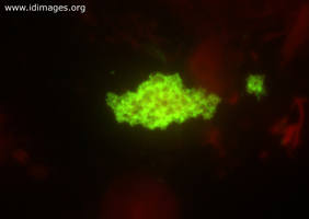Figure 1.  <i>Pneumocystis jirovecii</I>, shown by direct  fluorescent antibodies.