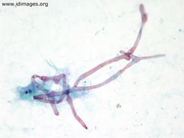Figure 1.  Rhizopus, shown by Papanicolaou stain.