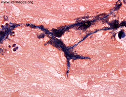 Figure 1.  <i>Scedosporium</i>,  the asexual form of  <i>Pseudallescheria</i>, gram stain of brain biopsy.