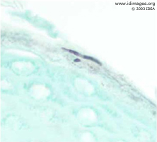 Figure 1. <i>Trichophyton rubrum</i>, seen with  GMS stain of skin biopsy.