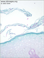 Figure 2.  <i>Trichophyton rubrum</i>, in skin,  biopsy with PAS stain.