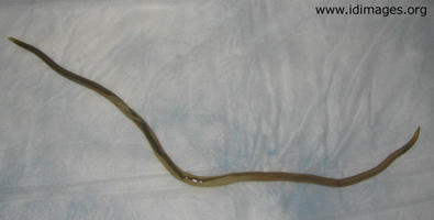 Figure 1.  <i>Ascaris</i> nematode, 12 inches in length, found on defecation.