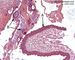 Figure 1.  <i>Taenia solium</i> shown by hematoxylin  and eosin stain of resected thecal cyst, with  cyst wall A and mineralized calcareous bodies B. 