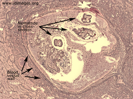 Figure 2.  Dirofilarial nematode seen by reticulin  stain, from resected lung nodule.