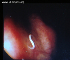 Figure 1.  <i>Trichuris trichiura</i> (whipworm)  seen on  colonoscopy.