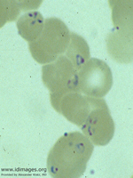 Figure 1.  Peripheral blood smear showing  the ring and Maltese cross forms of Babesia.