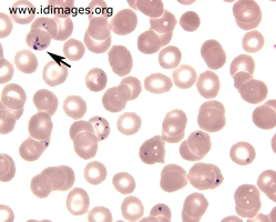 Figure 2.  Babesia seen on Giemsa staining of  the peripheral blood smear (thin smear).