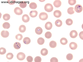 Figure 3. Babesia, on Giemsa staining of the  peripheral blood smear (thin smear).