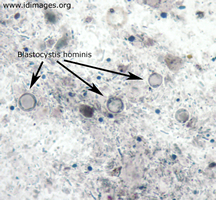Figure 1.  <i>Blastocystis hominis</i> shown by chlorazol black staining of stool specimen.