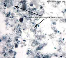 Figure 1.  <i>Dientamoeba fragilis</i> trophozoites  seen by chlorazol black staining of stool specimen.