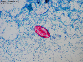 Figure 1.  <i>Isospora belli</i> seen by modified acid  fast stain of stool.