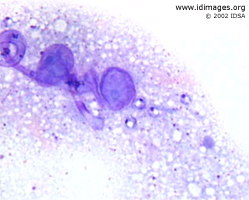 Figure 4.  <i>Leishmania braziliensis</i> shown by Giemsa stain of a skin biopsy.