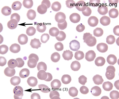 Figure 1.  <i>Plasmodium falciparum</i> on thin  smear of blood, Giemsa stain, 