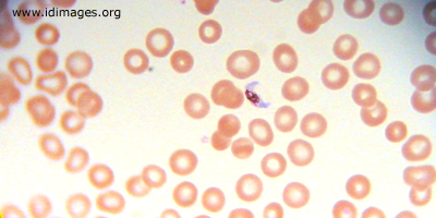 Figure 2.  <i>Plasmodium falciparum</i> banana gametocyte on thin smear.