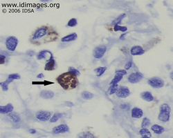 Figure 1.  <i>Toxoplasma gondii</i> encysted form, on  immunohistochemical staining of lung biopsy.