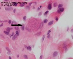 Figure 2.  <i>Toxoplasma gondii</i> on H and E stain  of lung biopsy.