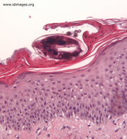 Figure 1.  <i>Sarcoptes scabiei</i> on skin biopsy.                           
