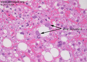 Figure 2.  HSV viral inclusions shown by staining of liver specimen.