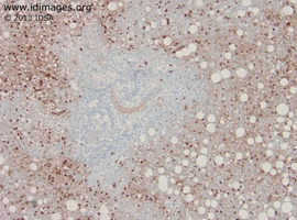 Figure 3. HSV-1 shown by immunohistochemical staining of liver tissue.