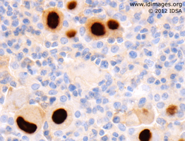 Figure 1.  CMV immunoperoxidase staining of enlarged nuclei in lung tissue.