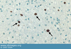Figure 1.  JC virus antigens shown by immunostain  on brain biopsy.