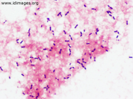 Figure 2.  <i>Enterococcus faecalis</i> shown by gram stain of blood culture.