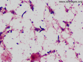 Figure 1.  <i>Rhodococcus equi</i> shown on gram stain of blood culture growth, with bacillary and coccal forms.