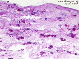 Figure 3.  <i>T. whipplei</i> seen by  PAS staining of pericardial tissue. 